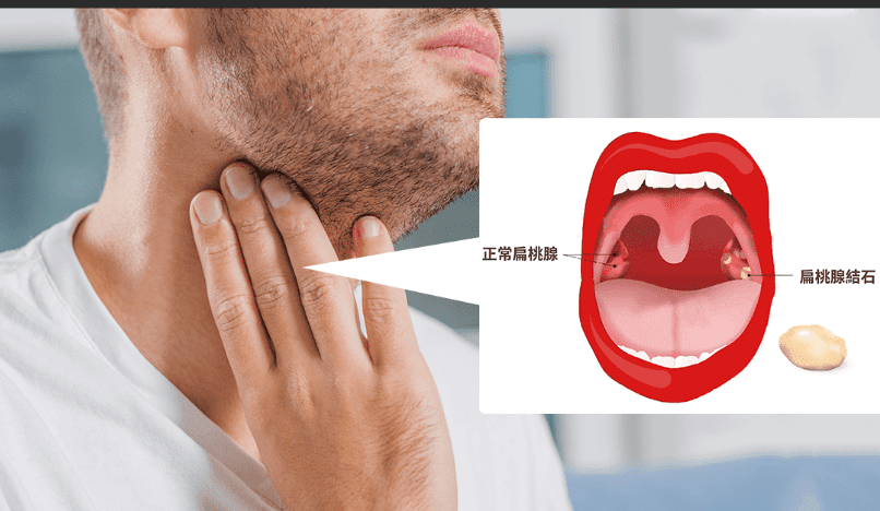 扁桃腺結石會自己消失嗎