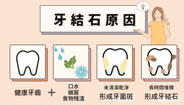 牙結石原因