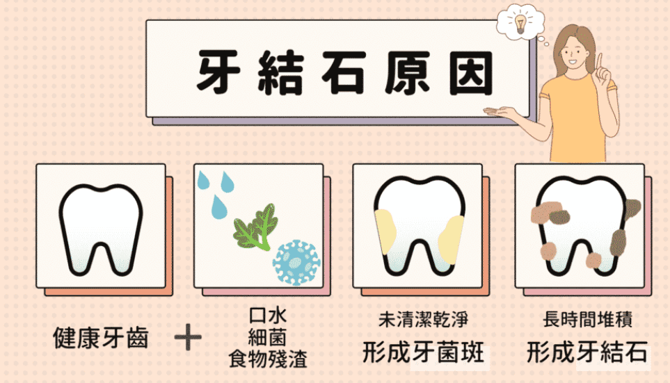 牙結石原因