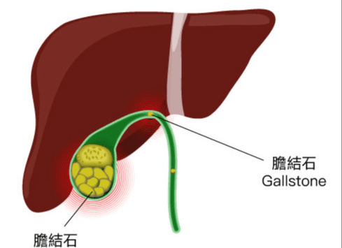 膽結石
