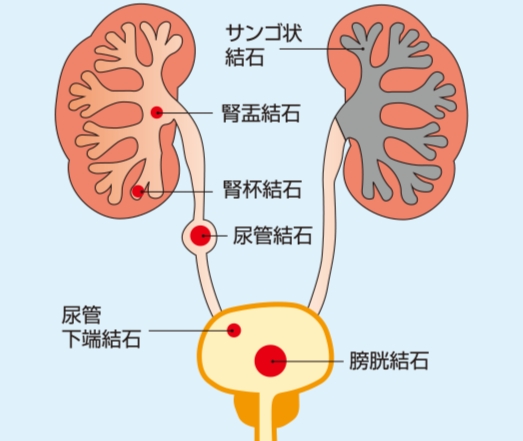 膀胱結石​
