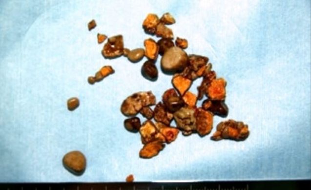 膀胱結石症狀