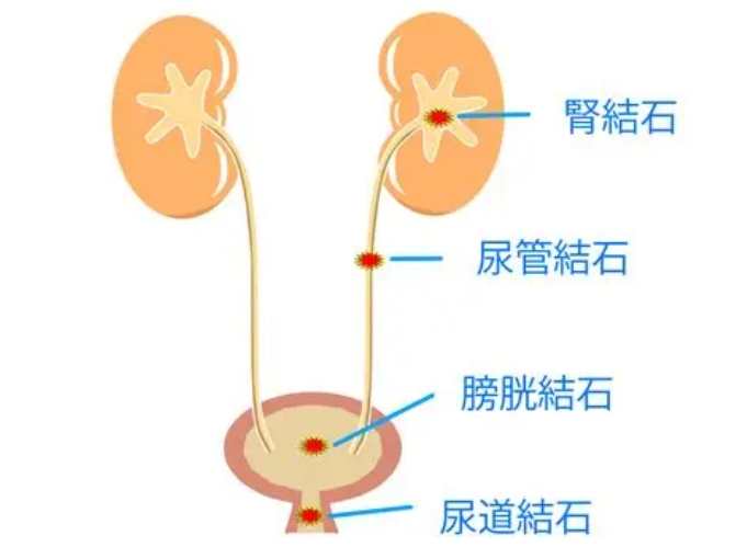 輸尿管結石症狀 輸尿管結石症狀