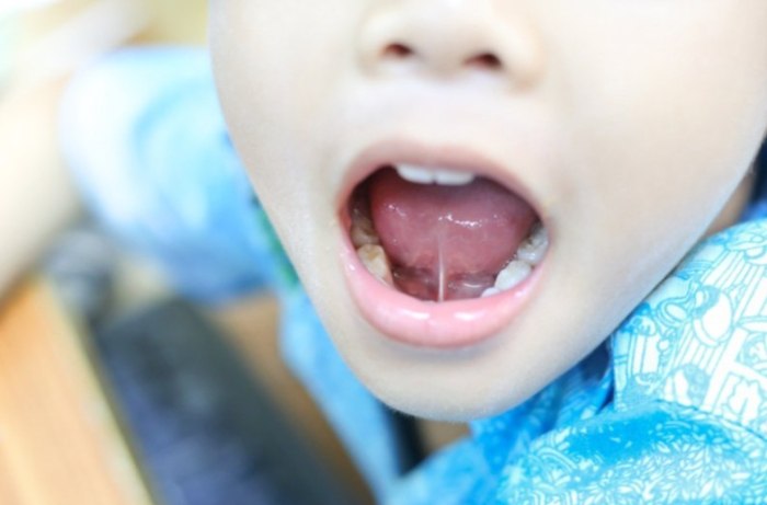 唾液腺結石手術