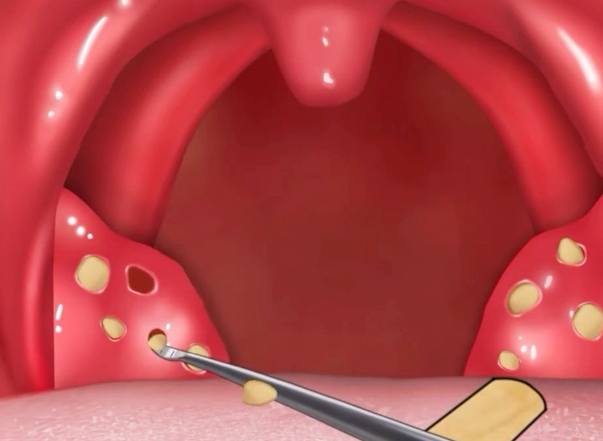 扁桃腺結石症狀