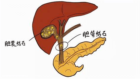 膽結石症狀 膽結石症狀