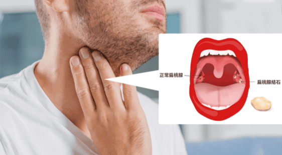 扁桃腺結石手術 扁桃腺結石手術