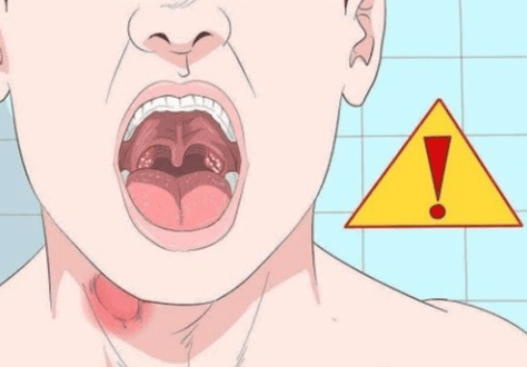 扁桃腺結石成因 扁桃腺結石成因