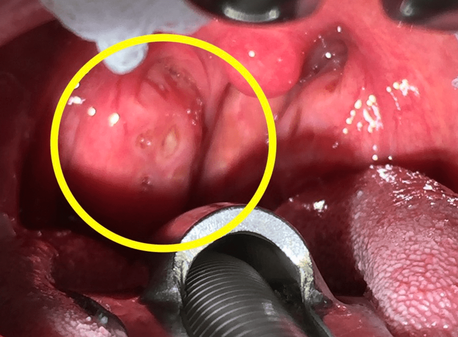 如何自行清理扁桃腺結石?扁桃腺結石預防方法 如何自行清理扁桃腺結石?扁桃腺結石預防方法