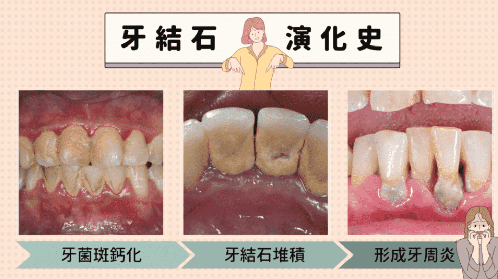 牙結石是什麼 牙結石是什麼