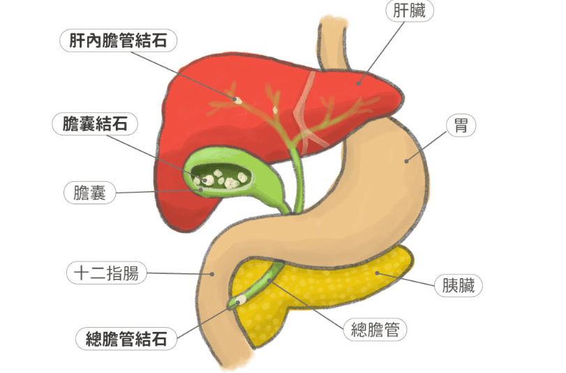 膽結石診斷 膽結石診斷