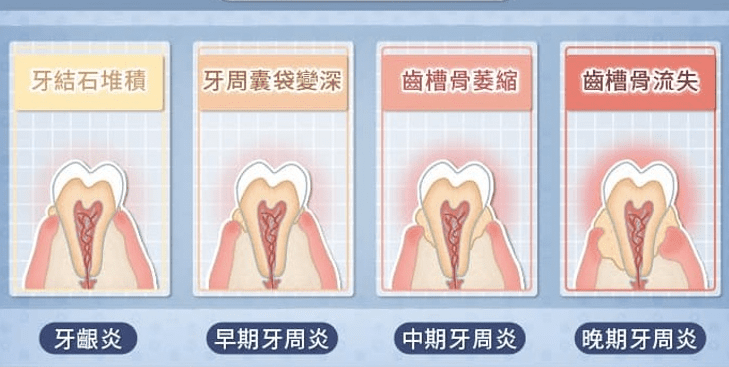 牙結石自己清除 牙結石自己清除