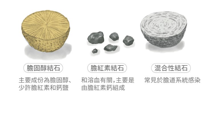 膽結石治療 膽結石治療