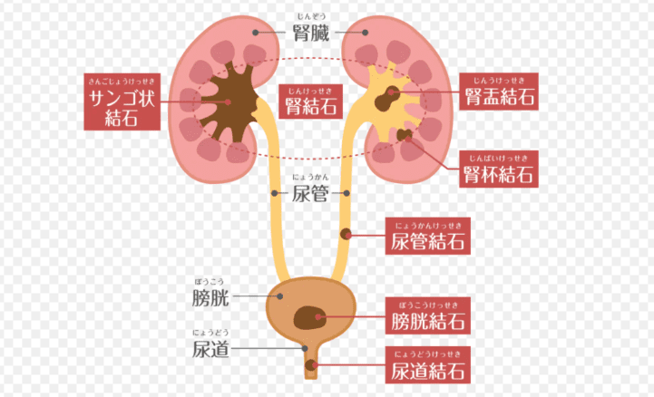 腎結石腰痛位置 腎結石腰痛位置