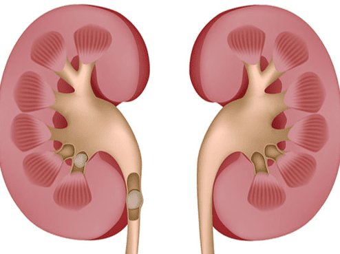 腎結石危害 腎結石危害