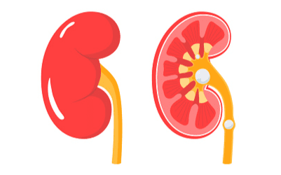 腎結石形成原因 腎結石形成原因